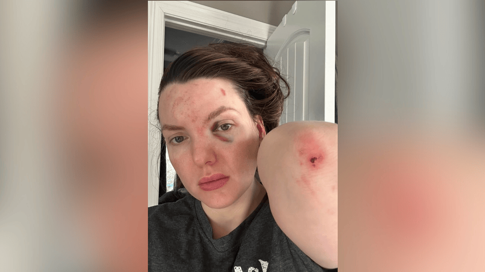 Nurse Attacked in Parking Lot Near UMMC—Speaks Out On Social Media