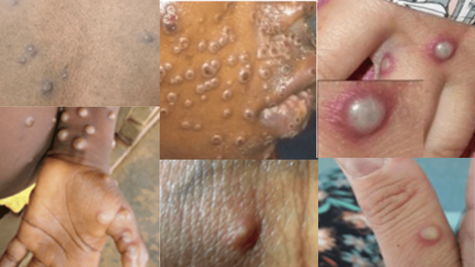 WHO Declares Mpox an International Public Health Emergency, What Nurses Need To Know 2024