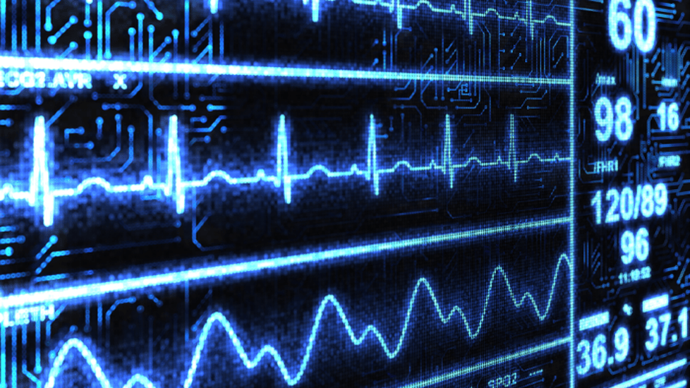Decreased Cardiac Output Nursing Diagnosis & Care Plan