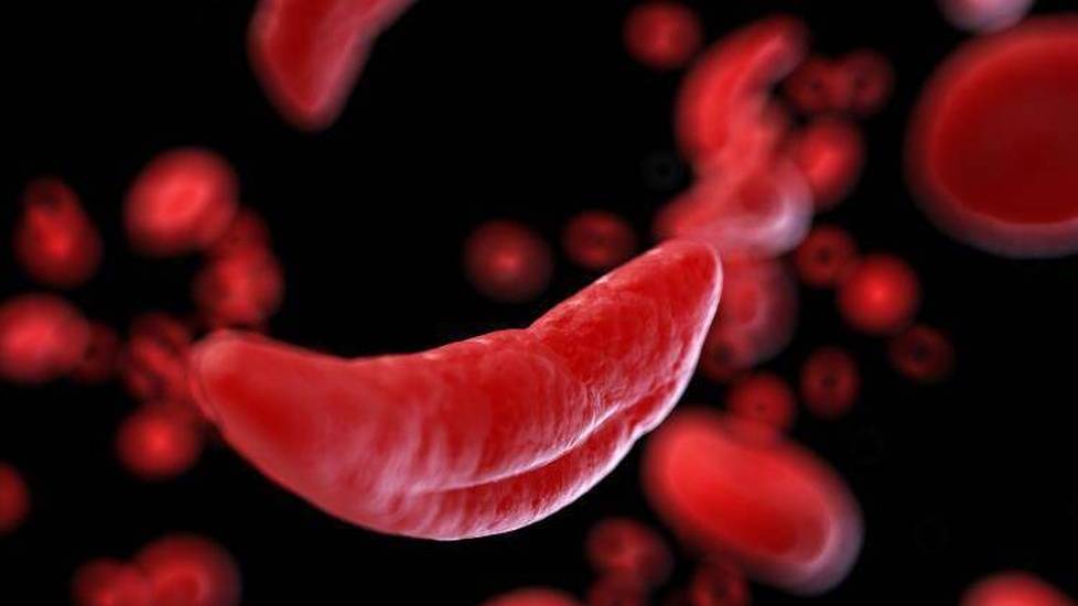 Sickle Cell Disease (SCD) Patients Often Mistreated: What Nurses Can Do