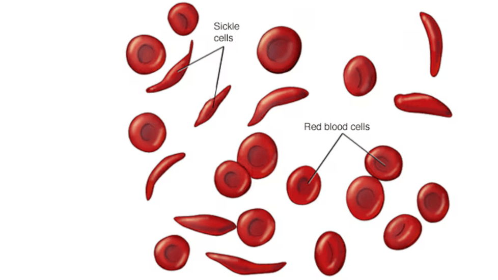 FDA Approves Gene Therapy for Sickle Cell Disease