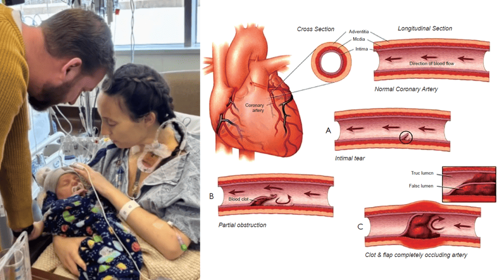 Postpartum Nurse’s Double Heart Attack Sheds Light on Hidden SCAD Risk