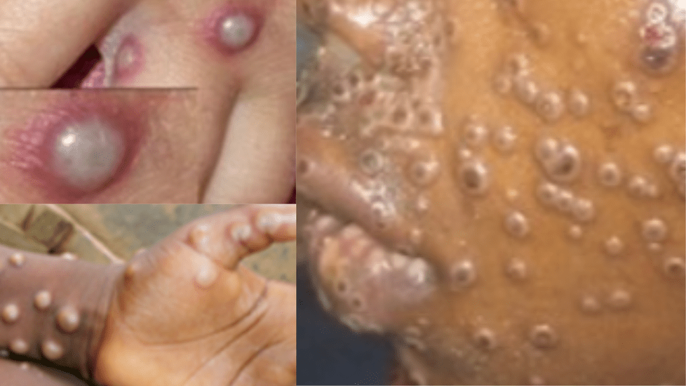 Monkeypox Renamed to "Mpox" by WHO, Here's Why